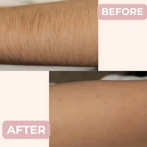 Painless Laser Hair Remover + Free UV Protective Glasses®