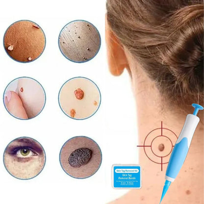 Wart Removal Pen (Skin Tags)