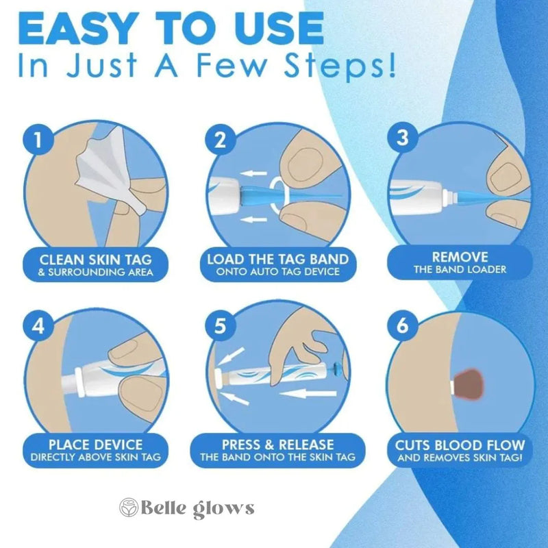 Wart Removal Pen (Skin Tags)