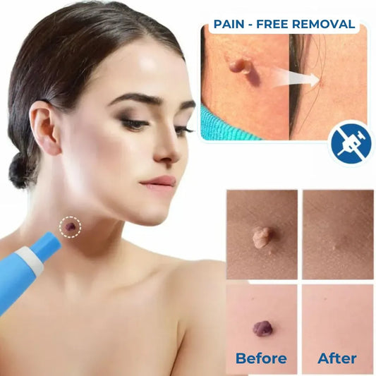 Wart Removal Pen (Skin Tags)