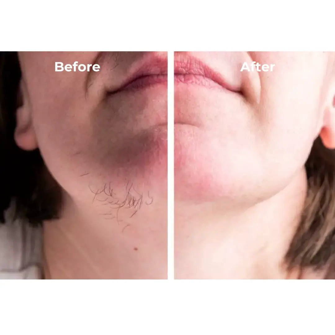 Beauty Kit - Facial & Body Hair Removal Pens + Eyebrow Pen®
